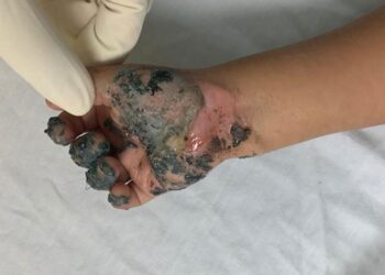 5 niños diarios sufren quemaduras por cuetes