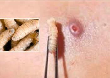 Dos nuevos casos de gusano barrenador en humanos: suman siete en Guerrero