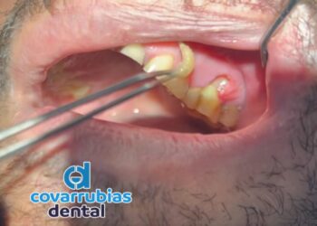 En Petatlán detectan caso de Gusano Barrenador en Humano: Alertan Sobre Caso Detectado en Clínica Dental