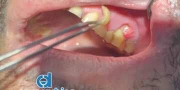 En Petatlán detectan caso de Gusano Barrenador en Humano: Alertan Sobre Caso Detectado en Clínica Dental